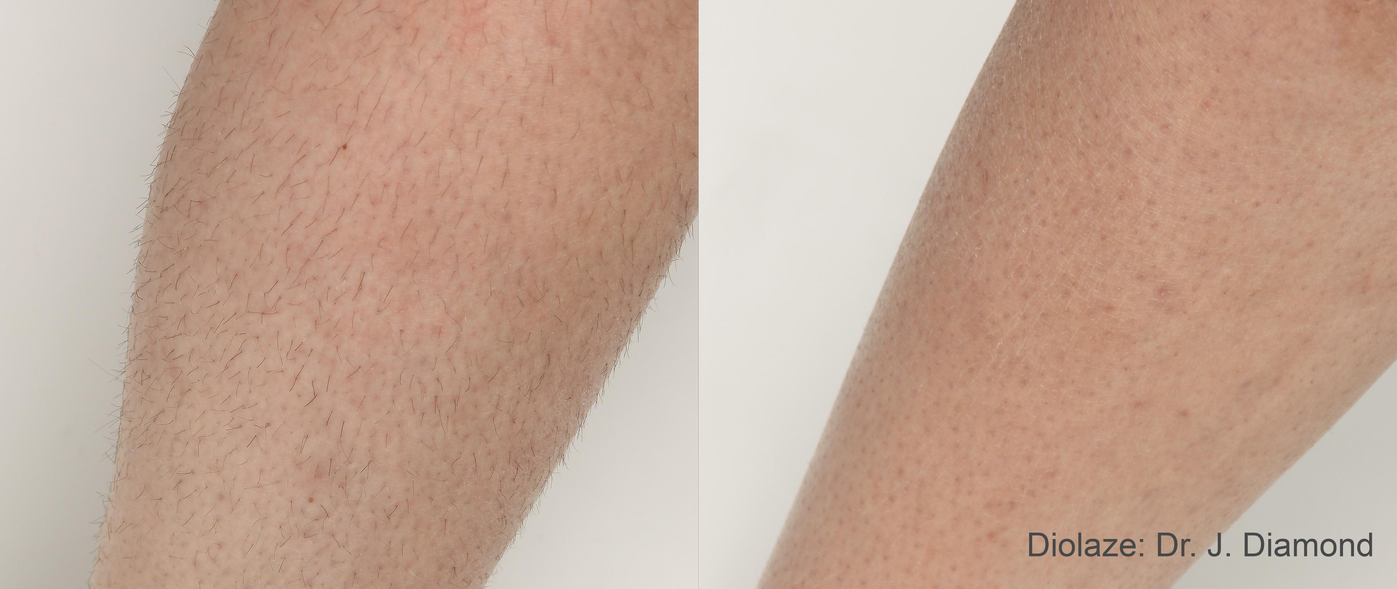 Before and after photos of laser hair removal